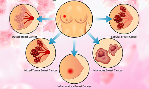 Types Of Breast Cancer