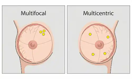 Multifocal vs Multicentric Cancer