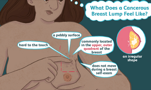 What does a cancerous breast lump feel like
