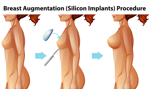 Types of Breast Implants, Cost, Problems, Lifespan