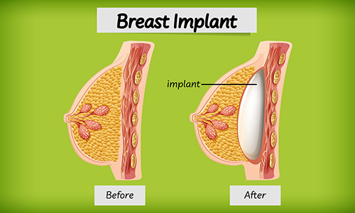 breast-Implant-meaning