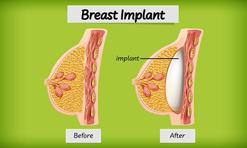 Types of Breast Implants Cost Problems Lifespan