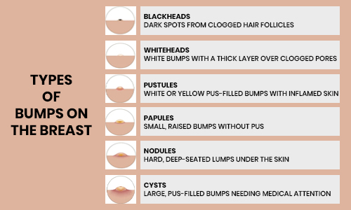 An informative image displaying various types of breast acne, illustrating their distinct characteristics and variations.