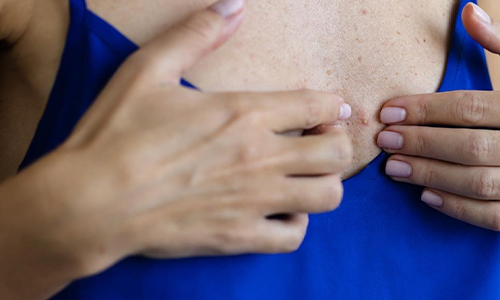 A focused view of breast skin with pimples, representing the discussion around causes and treatments for breast acne.