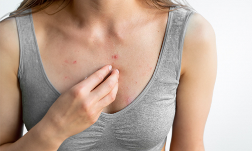 A woman showing a rash on her chest, looking concerned while examining her skin in a well-lit room.