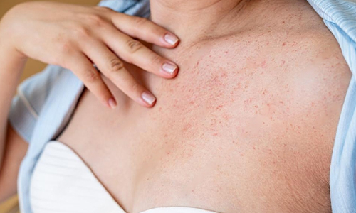 Close-up of a woman's chest area affected by a yeast infection, highlighting the skin condition.