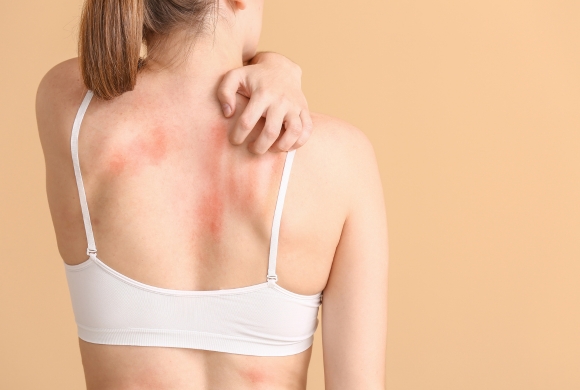 Say Goodbye to Bra Marks with Simple Solutions