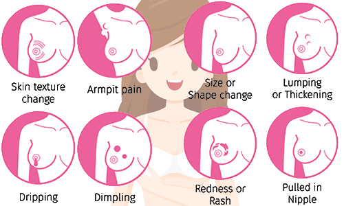 What Are the Signs and Symptoms of Breast Cancer?